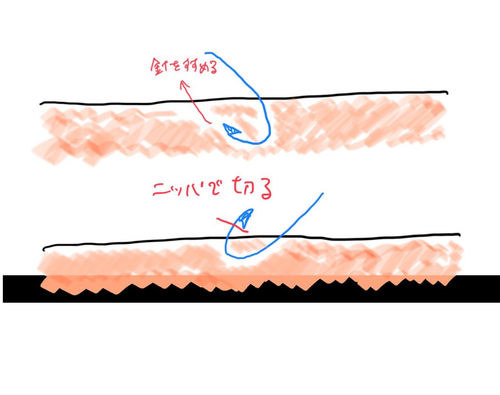 救急医が教える 痛くない釣り針の抜き方 救急医の小部屋